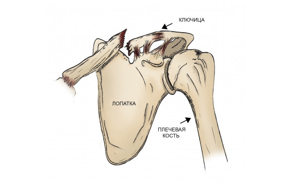 Поднадкостничный перелом