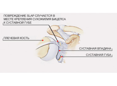 Повреждение SLAP