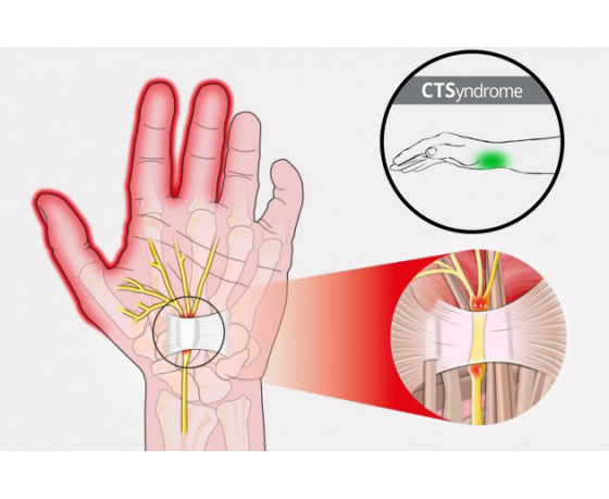 Система запястных туннелей - CTSyndrome