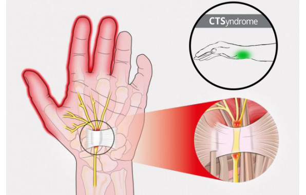 Система запястных туннелей - CTSyndrome