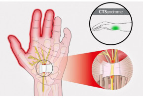 Система запястных туннелей - CTSyndrome