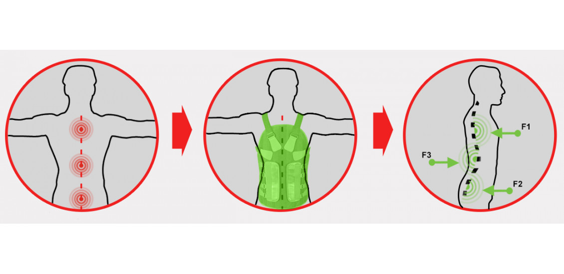 Ортез TLSO образует 3-точечное распределение усилий