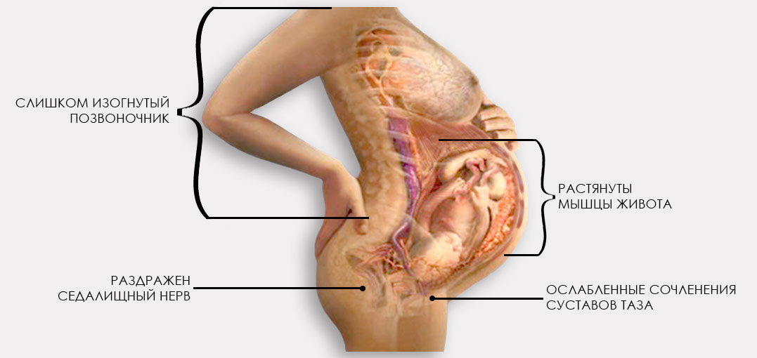 Защемление седалищного нерва у беременных