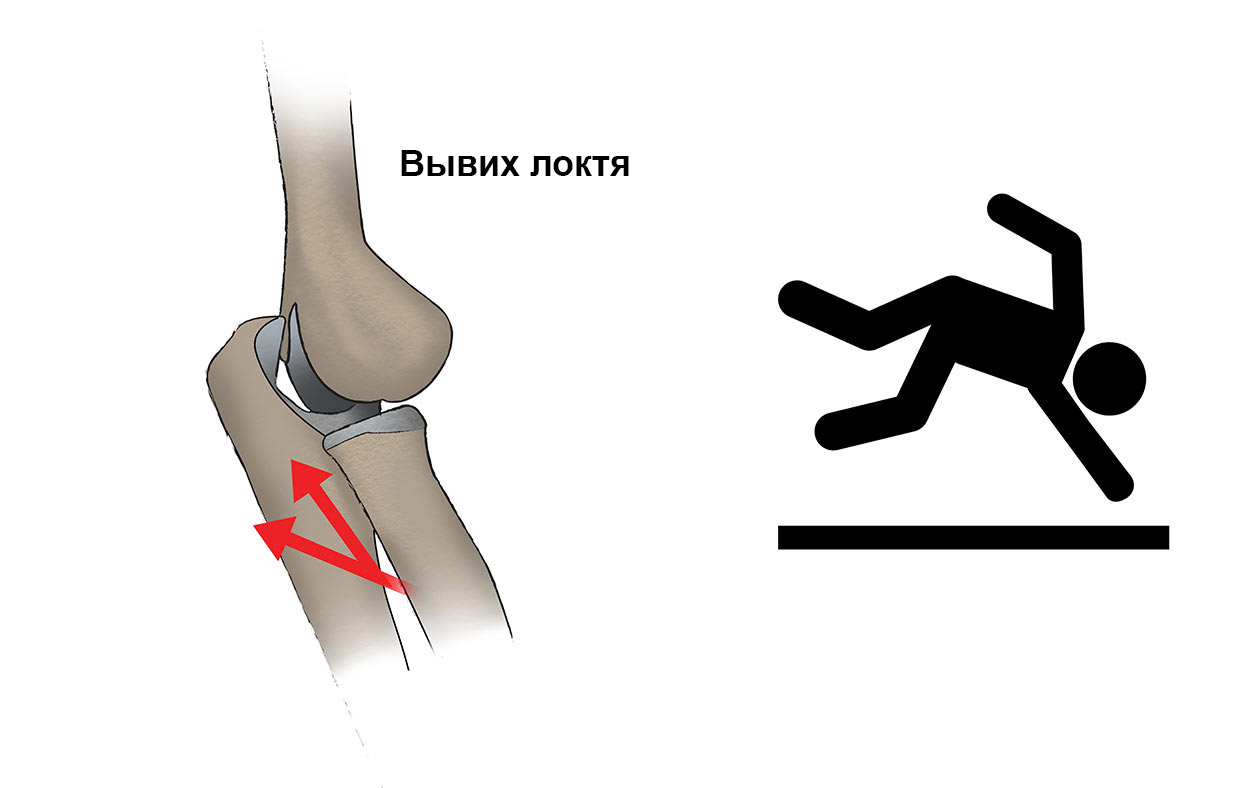 Переломы локтевого отростка