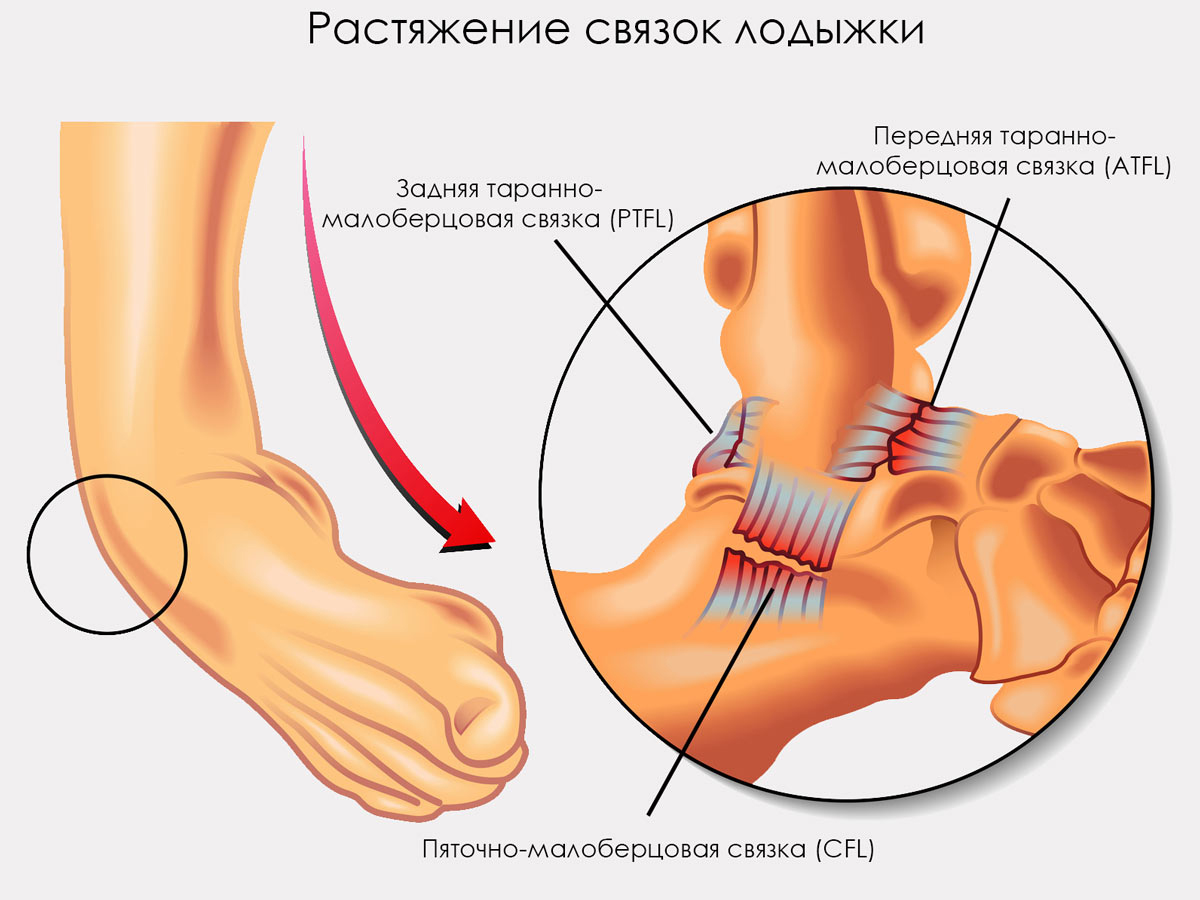 Лечение повреждения связок голеностопного сустава