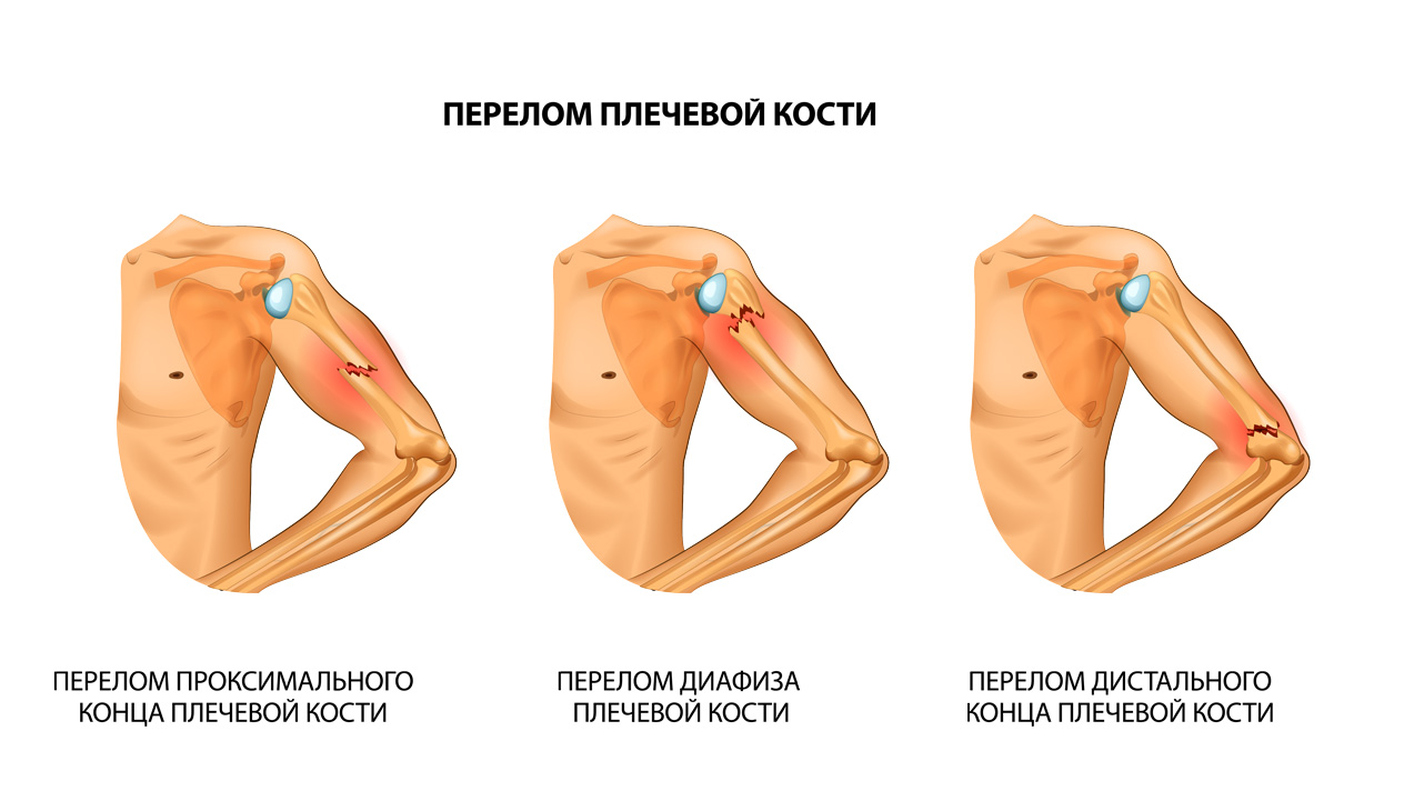 Детский ортез плеча Reh4Mat FIX-KG-22 – купить по цене 16100 руб. в Москве  | интернет-магазин allorto.ru